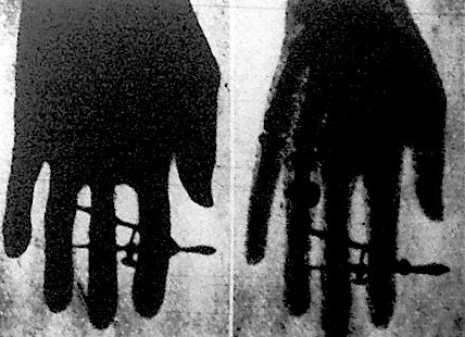Két átvilágított kéz. A jobboldalit rádium, a baloldalit röntgensugarakkal világították át. Kép forrása: huszadikszazad.hu, 2020. november 9.